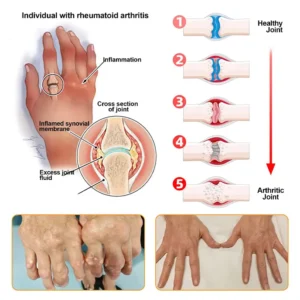 𝗙𝗗𝗔 𝗖𝗲𝗿𝘁𝗶𝗳𝗶𝗲𝗱 · 𝗢𝗳𝗳𝗶𝗰𝗶𝗮𝗹 𝗦𝘁𝗼𝗿𝗲 | Purelora®🔥 BEE VENOM LITHOSPERMUM Pain-Relief Bone Healing Cream 👑👑(Specially for older adults)