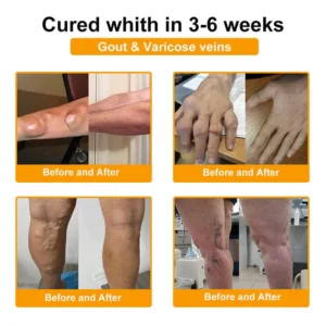 𝗙𝗗𝗔 𝗖𝗲𝗿𝘁𝗶𝗳𝗶𝗲𝗱 · 𝗢𝗳𝗳𝗶𝗰𝗶𝗮𝗹 𝗦𝘁𝗼𝗿𝗲 | Purelora®🔥 BEE VENOM LITHOSPERMUM Pain-Relief Bone Healing Cream 👑👑(Specially for older adults)