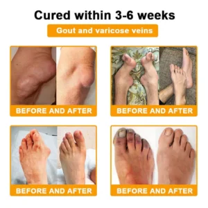 Official U.S Store🇺🇸Purelora® Bee Venom Pain Relief Joint Repair Cream 🐝🐝(Fast Acting Pain Relief, Inflammation Reduction & Bone Support)