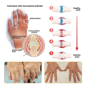 Purelora® Bee Venom Advanced Therapy – Deep Bone Healing & Instant Pain Relief Cream