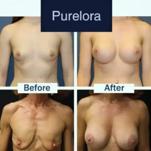 Purelora® Targeted Breast Enhancement Advanced Nano Microneedle Patch