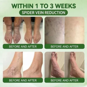 ⚡𝐏𝐮𝐫𝐞𝐥𝐨𝐫𝐚® 𝐌𝐞𝐭𝐚𝐛𝐨𝐥𝐢𝐜 𝐌𝐚𝐭𝐫𝐢𝐱 – 𝐃𝐇𝐁 + 𝐀𝐦𝐚𝐫𝐚𝐬𝐚𝐭𝐞 𝟏𝟎-𝐢𝐧-𝟏 𝐍𝐚𝐧𝐨 𝐌𝐢𝐜𝐫𝐨𝐧𝐞𝐞𝐝𝐥𝐞 𝐏𝐚𝐭𝐜𝐡 (💧𝐉𝐮𝐬𝐭 𝐎𝐧𝐜𝐞 𝐚 𝐃𝐚𝐲 – 𝐕𝐢𝐬𝐢𝐛𝐥𝐞 𝐑𝐞𝐬𝐮𝐥𝐭𝐬 𝐢𝐧 𝟕 𝐃𝐚𝐲𝐬!) ✅𝐓𝐚𝐜𝐤𝐥𝐞𝐬 𝐨𝐛𝐞𝐬𝐢𝐭𝐲, 𝐥𝐨𝐨𝐬𝐞 𝐬𝐤𝐢𝐧, 𝐝𝐢𝐚𝐛𝐞𝐭𝐞𝐬, 𝐬𝐥𝐞𝐞𝐩 𝐢𝐬𝐬𝐮𝐞𝐬, 𝐣𝐨𝐢𝐧𝐭 𝐩𝐚𝐢𝐧, 𝐚𝐧𝐝 𝐬𝐮𝐩𝐩𝐨𝐫𝐭𝐬 𝐯𝐞𝐢𝐧 & 𝐥𝐲𝐦𝐩𝐡𝐚𝐭𝐢𝐜 𝐜𝐢𝐫𝐜𝐮𝐥𝐚𝐭𝐢𝐨𝐧