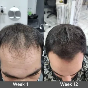 🇺🇸 Official U.S. Store | PURELORA® 2-in-1 Onion & Rosemary Shampoo + Conditioner 🌿 | 15X Active Complex for Fuller, Thicker-Looking & Stronger Hair