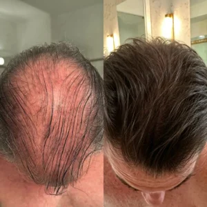 🌿👨‍⚕️ Official US Store 🇺🇸 | 🔥 PURELORA® Onion & Rosemary 2-in-1 Shampoo & Conditioner with 15X Active Complex for Hair Growth: For hair that looks thicker, fuller, and stronger