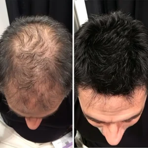 🌿👨‍⚕️ Official US Store 🇺🇸 | 🔥 PURELORA® Onion & Rosemary 2-in-1 Shampoo & Conditioner with 15X Active Complex for Hair Growth: For hair that looks thicker, fuller, and stronger