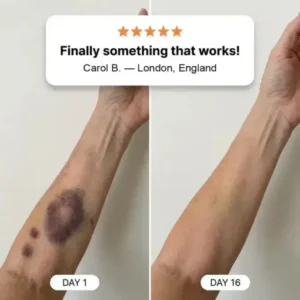 PURELORA® cream to repair bruises and strengthen the skin