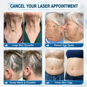 Purelora® 𝟕-𝐃𝒂𝘆 𝐒𝗸𝐢𝐧 𝐓𝒂𝗴 & 𝐒𝐩𝙤𝐭 𝐄𝐫𝒂𝐬𝙚𝐫 Painless & Scar-Free Advanced Imperfection Remova𝗜 Ro𝗜𝗜erba𝗜𝗜 Pen