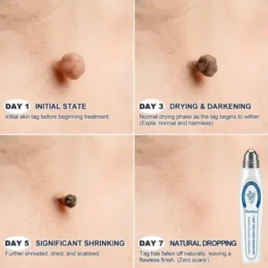 Purelora® 7-𝐷𝑎𝑦 𝗧𝐚𝐠 & 𝗦𝗽𝐨𝐭 𝐄𝐫𝒂𝒔𝒆𝒓(Zero Pain, Zero 𝐒𝐜𝐚𝒓𝒔 Rollerball)