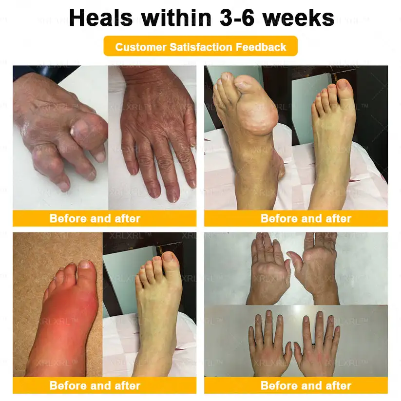 Purelora®💞💞 Bee Venom Pain-Relief Bone Healing Cream (Specially for older adults)