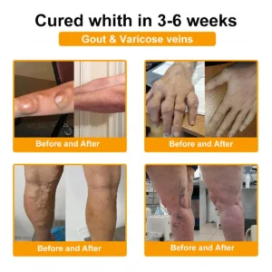 Purelora®💞💞 Bee Venom Pain-Relief Bone Healing Cream (Specially for older adults)