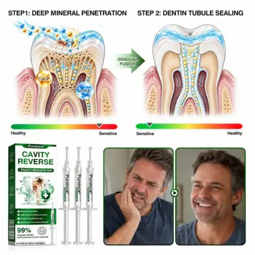Purelora® CavityReverse Pept11 MicroFill Gel
