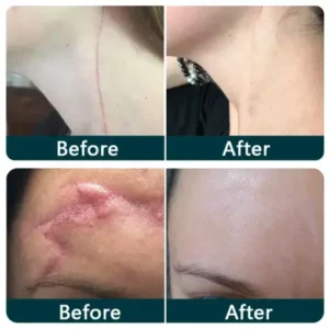 Purelora® SILICONE SCAR THERAPY ROLL