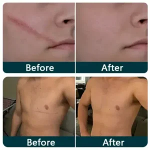 Purelora® SILICONE SCAR THERAPY ROLL