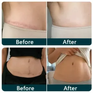 Purelora® SILICONE SCAR THERAPY ROLL