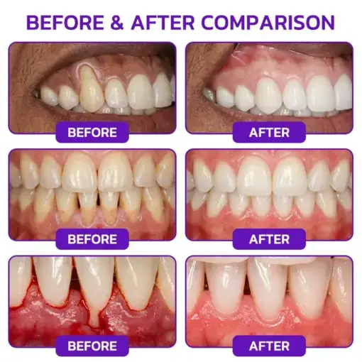 Purelora® VioGum Gingivitis & Periodontal Rescue Gel