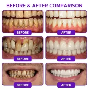 Purelora® VioGum Gingivitis & Periodontal Rescue Gel